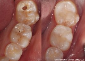 Repairing decayed teeth with tooth colored fillings