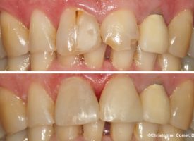 Repairing broken teeth and failing restorations.