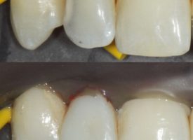 Repairing decayed teeth with tooth colored fillings.